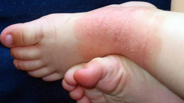 Dermatitis alérgicas 