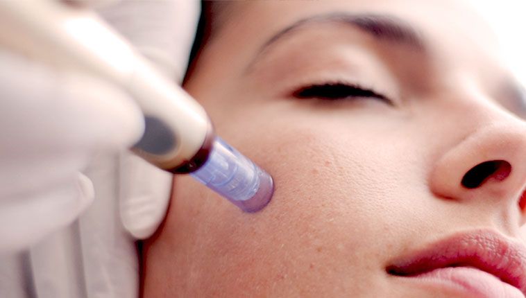 Microneedling