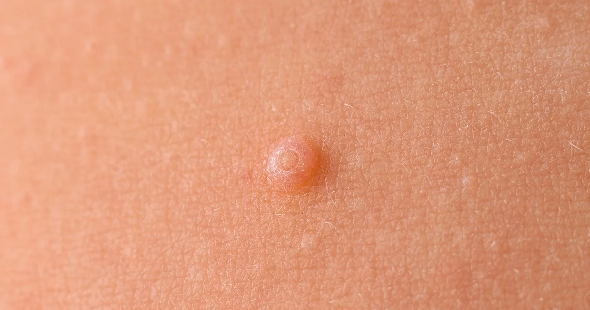 Moluscos contagiosos