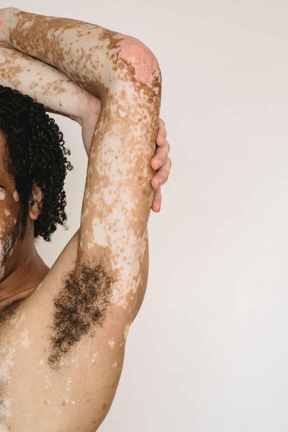 Vitiligo