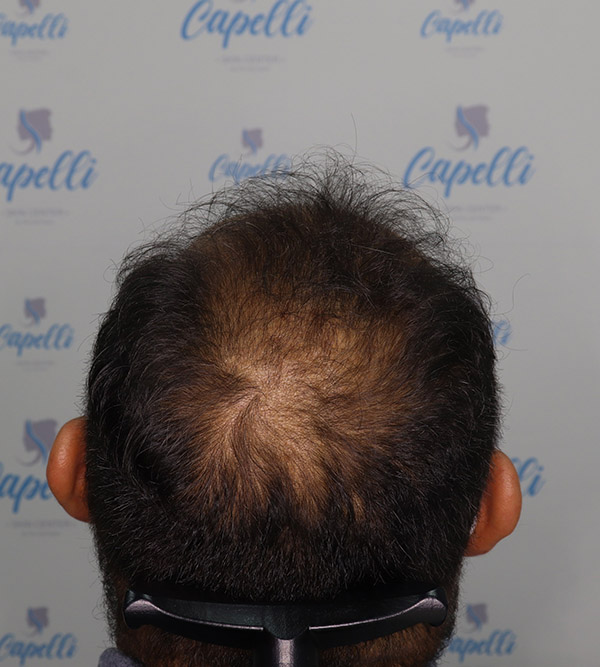 Alopecia