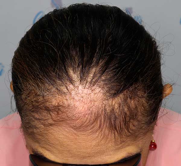 Alopecia cicatricial