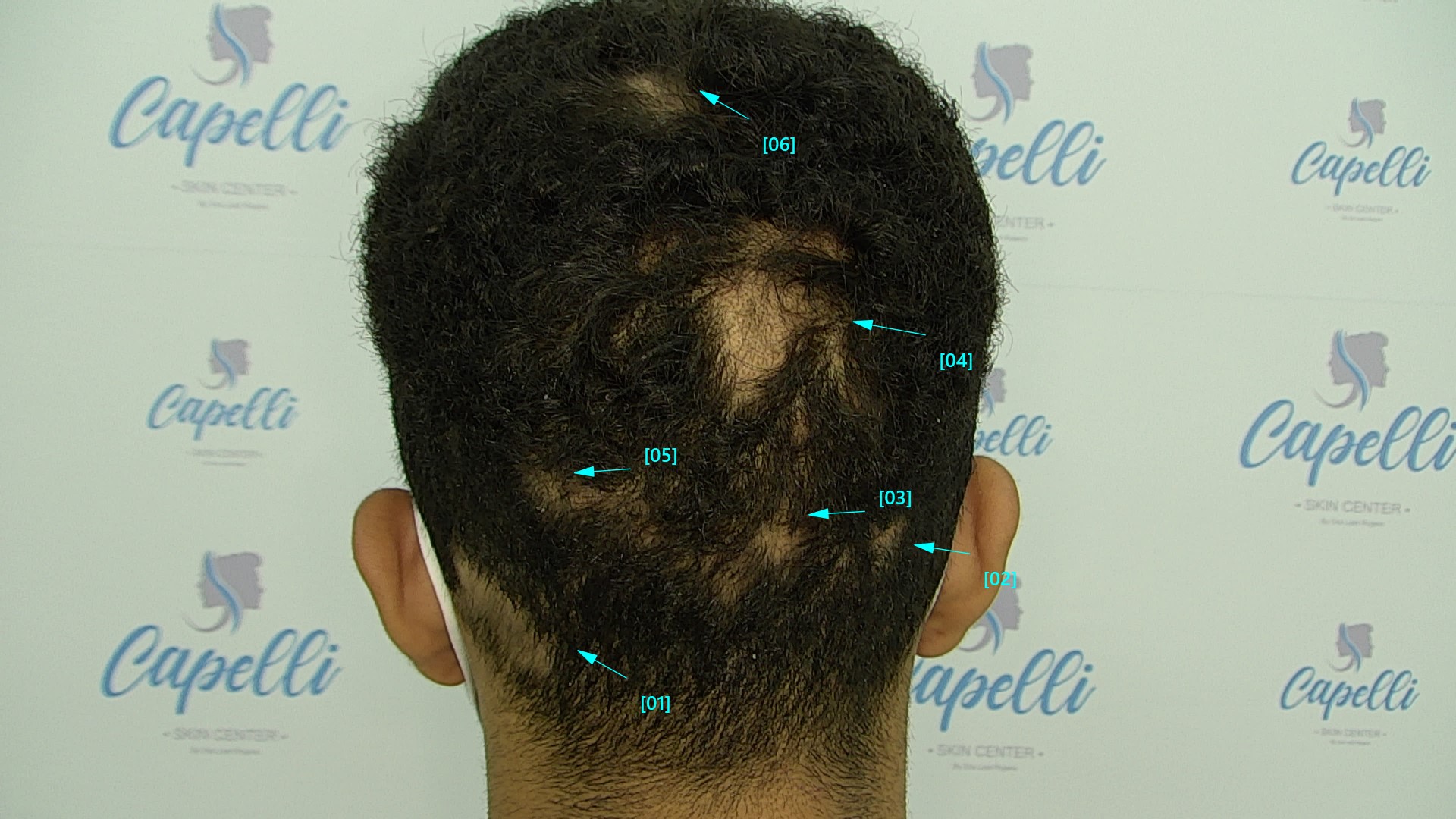 Alopecia Androgenetica - Capelli Skin Center