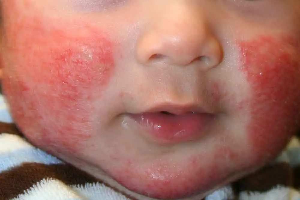 Dermatitis atópica 